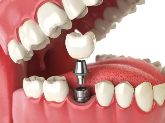 Image of Dental Implants