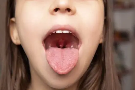Tongue Examination