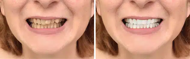 Before & After Dental Bonding