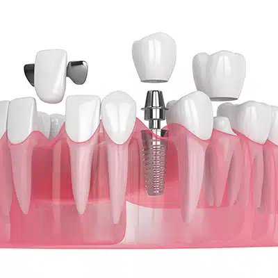 Image of Crowns & Caps in Pomerado Family Dental