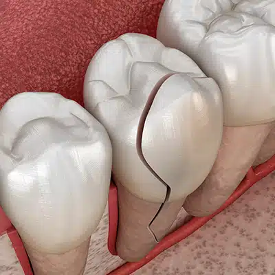 Chipped, cracked, or fractured tooth