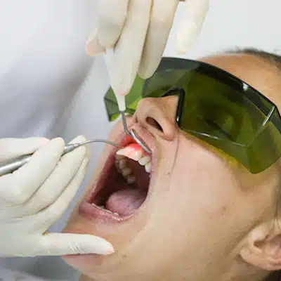 Laser Treatment in Pomerado Family Dental