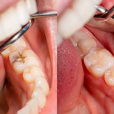 Before & After an image of Dental filling