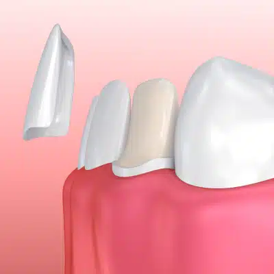 Image of veneers