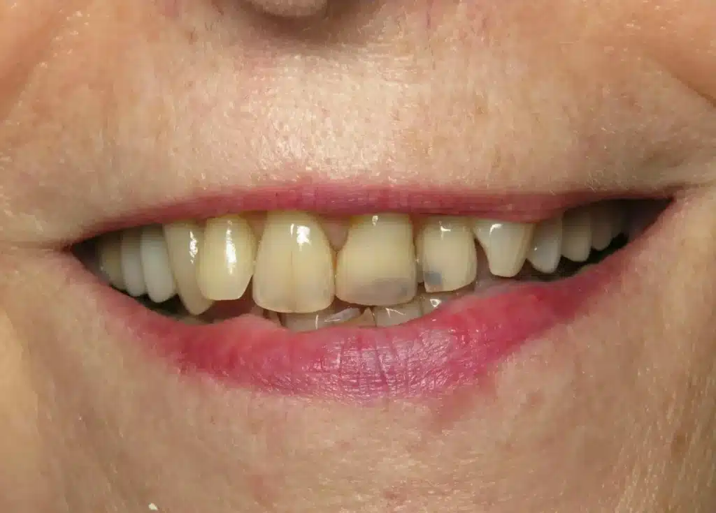 Before Smile Makeover - Cosmetic Restoration