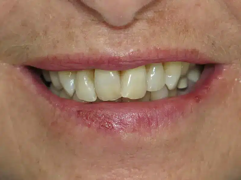 Before Smile Makeover - Crowns And Bridges