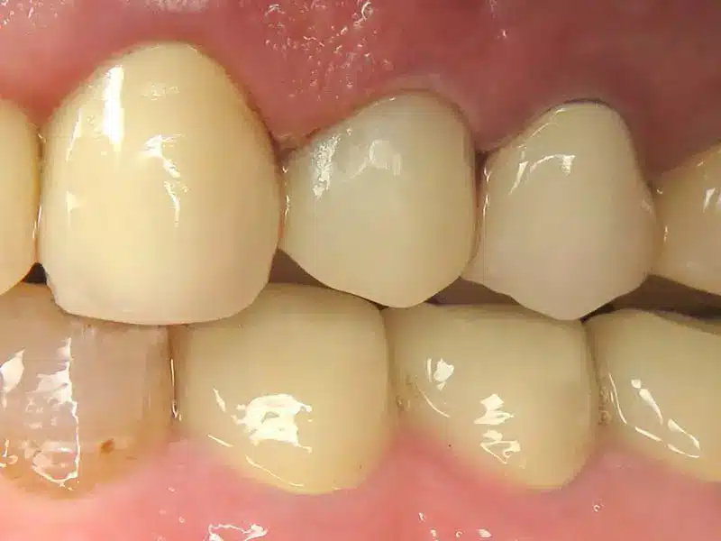 After Smile Makeover - Inlays and Onlays