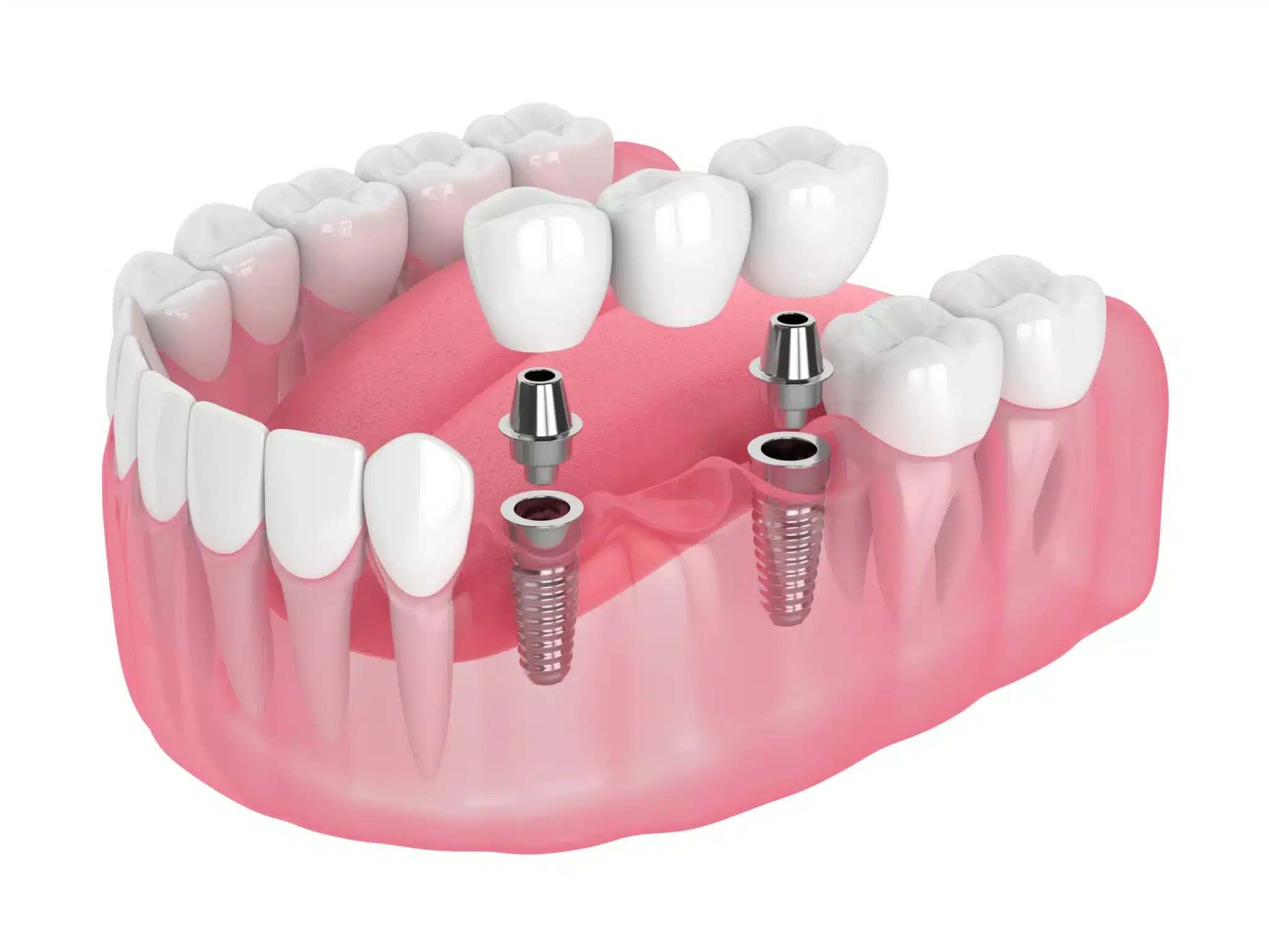 Implant Supported Bridges in Pomerado Family Dental