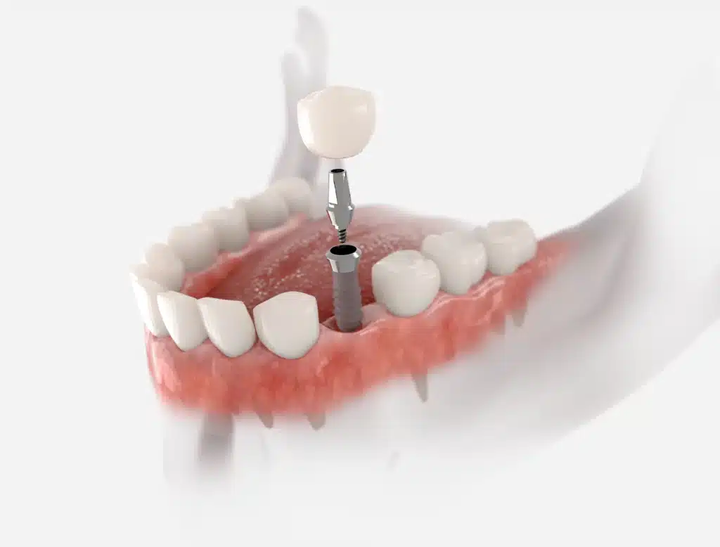 Implants Dentistry