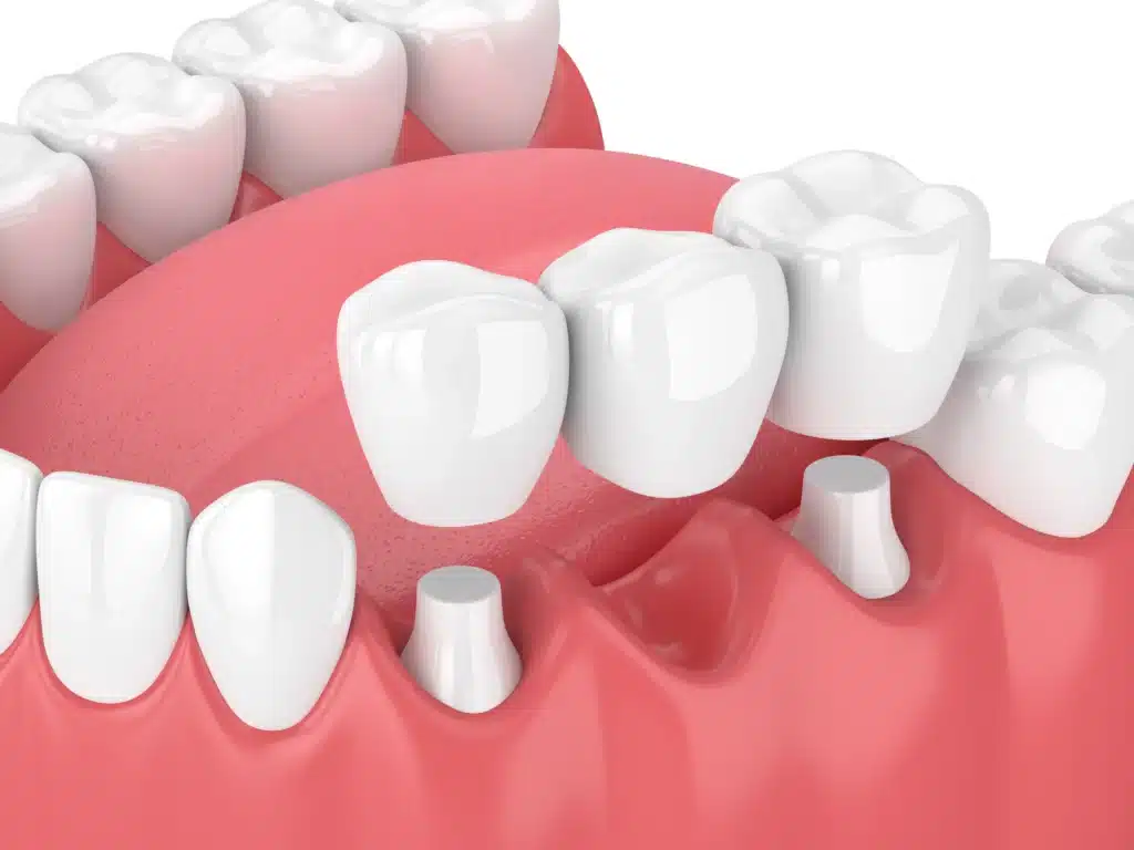 Implants Supported Bridges in Pomerado Family Dental