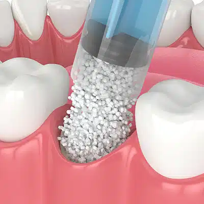 Bone Grafting at Pomerado Family Dental