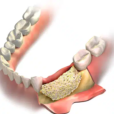 Bone Grafting