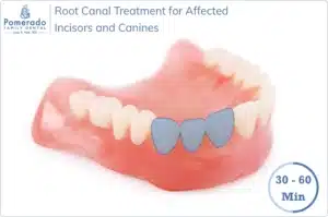 How long does Root Canal Take to treat Incisors and Canines