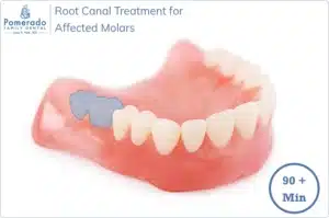 How long does Root Canal Take to treat Molars