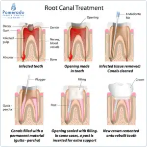 Infographic explaining Root Canal Treatment and Procedure