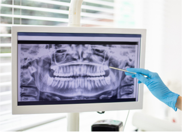 Digital Dental X-Ray on screen